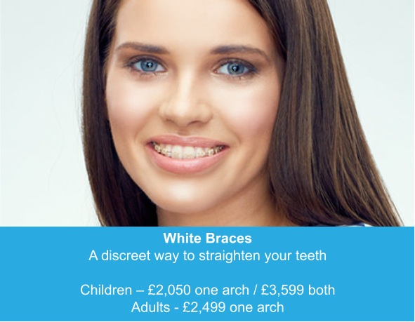 White Braces A discreet way to straighten your teeth  Children – £2,050 one arch / £3,599 both Adults - £2,499 one arch