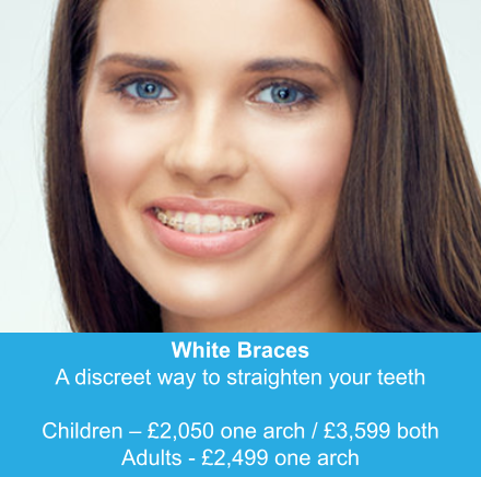 White Braces A discreet way to straighten your teeth  Children – £2,050 one arch / £3,599 both Adults - £2,499 one arch