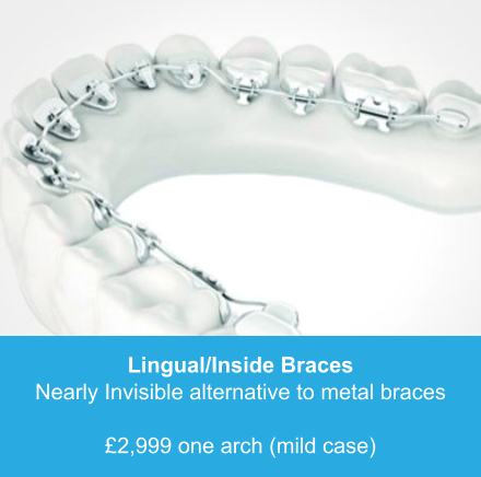 Lingual/Inside Braces Nearly Invisible alternative to metal braces  £2,999 one arch (mild case)